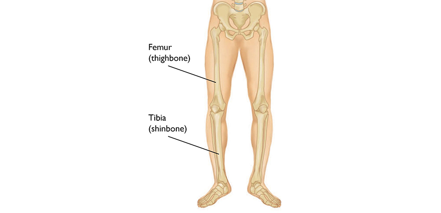 Lower Limb Fractures