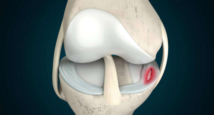 Meniscus Surgery