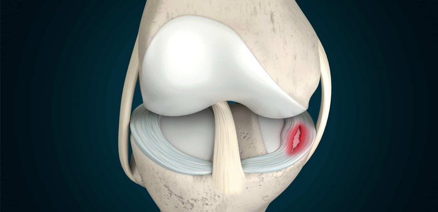 Meniscus Surgery