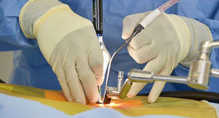 Minimally Invasive Spine Surgery