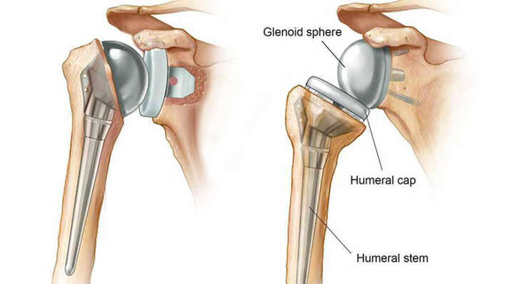 Shoulder Replacement Surgery