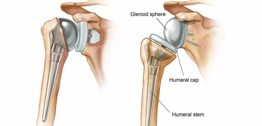 Shoulder Replacement Surgery