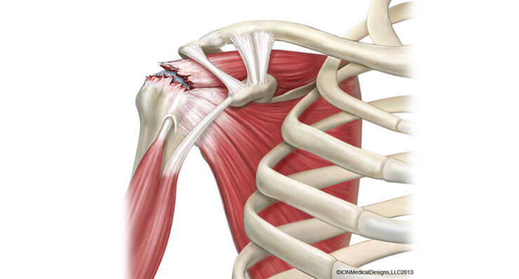 Shoulder Rotator Cuff Repair