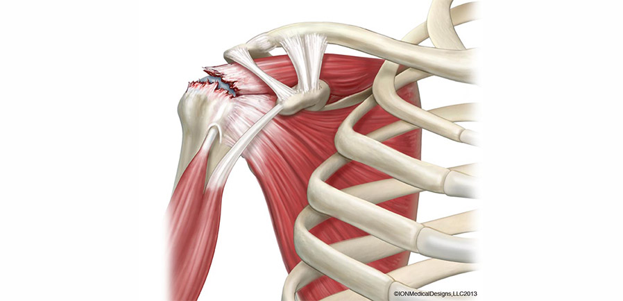 Shoulder Rotator Cuff Repair