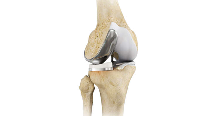 Unicondylar Knee Replacement Surgery