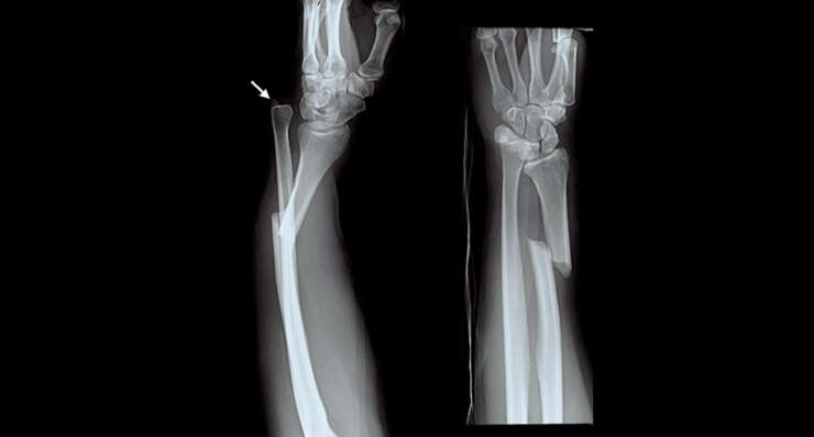 Upper Limb Fractures