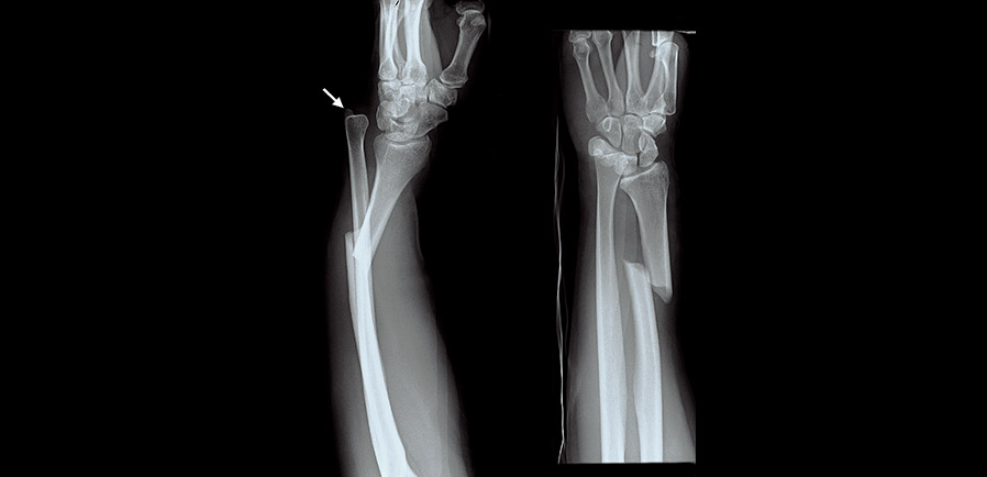 Upper Limb Fractures