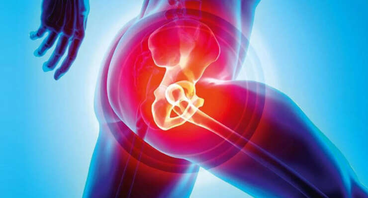 Hip Replacement Surgery